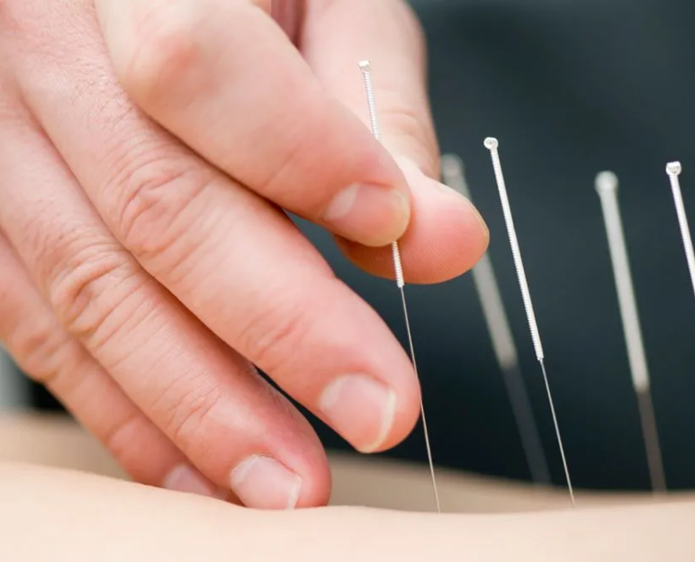 Dry needling